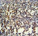 ANKRD49 Antibody - ANR49 Antibody IHC of formalin-fixed and paraffin-embedded human lymph carcinoma followed by peroxidase-conjugated secondary antibody and DAB staining.