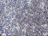 ANKRD53 Antibody - IHC of paraffin-embedded Human lymphoma tissue using anti-ANKRD53 mouse monoclonal antibody.