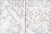 ANKS3 Antibody - Detection of Human and Mouse ANKS3 by Immunohistochemistry. Sample: FFPE section of human prostate carcinoma (left) and mouse teratoma (right). Antibody: Affinity purified rabbit anti-ANKS3 used at a dilution of 1:1000 (1 ug/ml).