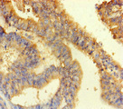 ANKS6 Antibody - Immunohistochemistry of paraffin-embedded human endometrial cancer at dilution of 1:100