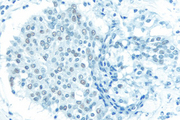 Breast Carcinoma: Without Citrate-based Antigen Unmasking Solution, Estrogen receptor (rm), ImmPRESS™ Anti-Rabbit Ig Kit, DAB (brown) substrate. Hematoxylin QS (blue) counterstain.
