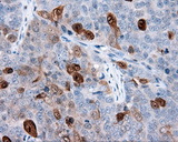 ANXA1 / Annexin A1 Antibody - IHC of paraffin-embedded Adenocarcinoma of ovary tissue using anti-ANXA1 mouse monoclonal antibody. (Dilution 1:50).