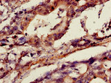 ANXA10 / Annexin A10 Antibody - Immunohistochemistry of paraffin-embedded human gastric cancer using ANXA10 Antibody at dilution of 1:100