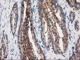 ANXA3 / Annexin A3 Antibody - IHC of paraffin-embedded Carcinoma of Human prostate tissue using anti-ANXA3 mouse monoclonal antibody.