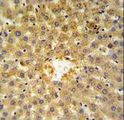 ANXA5 / Annexin V Antibody - Annexin V Antibody IHC of formalin-fixed and paraffin-embedded human hepatocarcinoma followed by peroxidase-conjugated secondary antibody and DAB staining. This data demonstrates the use of the Annexin V Antibody for immunohistochemistry.