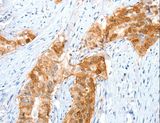 ANXA8 / Annexin A8 Antibody - Immunohistochemistry of paraffin-embedded Human cervical cancer using ANXA8 Polyclonal Antibody at dilution of 1:35.