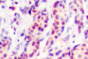 AP-1 / JUND Antibody - IHC of JunD (V249) pAb in paraffin-embedded human breast carcinoma tissue.