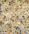 AP2A2 Antibody - Formalin-fixed and paraffin-embedded human hepatocarcinoma with AP2A2 Antibody , which was peroxidase-conjugated to the secondary antibody, followed by DAB staining. This data demonstrates the use of this antibody for immunohistochemistry; clinical relevance has not been evaluated.