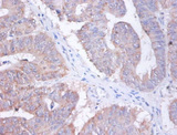 AP2S1 Antibody - Immunohistochemistry of paraffin-embedded human colon cancer using AP2S1 Antibody at dilution of 1:100