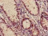 AP3M2 Antibody - Immunohistochemistry of paraffin-embedded human colon cancer using AP3M2 Antibody at dilution of 1:100