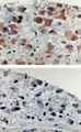 APAF1 / APAF-1 Antibody - Formalin-fixed, paraffin-embedded tissue sections of human brain tumors stained for Apaf 1 expression using APAF1 / APAF-1 at 1:2000. A. Gemistocytoma (grade II). B. Anaplastic glioma. A high level of Apaf 1was observed in the gemistocytoma whereas a low level was seen in the more malignant anaplastic glioma. Hematoxylin-Eos in counterstain.