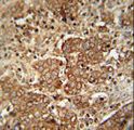 APCS / Serum Amyloid P / SAP Antibody - APCS antibody immunohistochemistry of formalin-fixed and paraffin-embedded human hepatocarcinoma followed by peroxidase-conjugated secondary antibody and DAB staining.