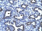 APEX1 / APE1 Antibody - APEX1 / APE1 antibody ARP32651_T100-NP_542379-APEX1 (APEX nuclease (multifunctional DNA repair enzyme) 1) Antibody was used in IHC to stain formalin-fixed, paraffin-embedded human lung.  This image was taken for the unconjugated form of this product. Other forms have not been tested.
