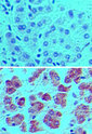 Apg7 / ATG7 Antibody - IHC ofAPG7L in formalin-fixed, paraffin-embedded human liver tissue using an isotype control (top) and Polyclonal Antibody to APG7L (bottom) at 5 ug/ml.