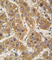 APOE / Apolipoprotein E Antibody - Formalin-fixed and paraffin-embedded human hepatocarcinoma tissue reacted with APOE antibody , which was peroxidase-conjugated to the secondary antibody, followed by DAB staining. This data demonstrates the use of this antibody for immunohistochemistry; clinical relevance has not been evaluated.