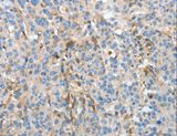 APOH / Apolipoprotein H Antibody - Immunohistochemistry of paraffin-embedded Human esophagus cancer using APOH Polyclonal Antibody at dilution of 1:30.