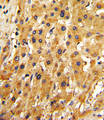 APRT Antibody - Formalin-fixed and paraffin-embedded human hepatocarcinoma with APRT Antibody , which was peroxidase-conjugated to the secondary antibody, followed by DAB staining. This data demonstrates the use of this antibody for immunohistochemistry; clinical relevance has not been evaluated.