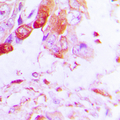 AQP5 / Aquaporin 5 Antibody - Immunohistochemical analysis of Aquaporin 5 staining in human lung cancer formalin fixed paraffin embedded tissue section. The section was pre-treated using heat mediated antigen retrieval with sodium citrate buffer (pH 6.0). The section was then incubated with the antibody at room temperature and detected using an HRP conjugated compact polymer system. DAB was used as the chromogen. The section was then counterstained with hematoxylin and mounted with DPX.