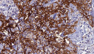 AQP8 / Aquaporin 8 Antibody - 1:100 staining human Head and neck carcinoma tissue by IHC-P. The sample was formaldehyde fixed and a heat mediated antigen retrieval step in citrate buffer was performed. The sample was then blocked and incubated with the antibody for 1.5 hours at 22°C. An HRP conjugated goat anti-rabbit antibody was used as the secondary.