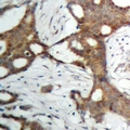 AR / Androgen Receptor Antibody - Immunohistochemical analysis of Androgen Receptor staining in human prostate cancer formalin fixed paraffin embedded tissue section. The section was pre-treated using heat mediated antigen retrieval with sodium citrate buffer (pH 6.0). The section was then incubated with the antibody at room temperature and detected using an HRP polymer system. DAB was used as the chromogen. The section was then counterstained with hematoxylin and mounted with DPX.