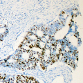 AR / Androgen Receptor Antibody - Immunohistochemical analysis of Androgen Receptor (pS650) staining in human prostate cancer formalin fixed paraffin embedded tissue section. The section was pre-treated using heat mediated antigen retrieval with sodium citrate buffer (pH 6.0). The section was then incubated with the antibody at room temperature and detected using an HRP conjugated compact polymer system. DAB was used as the chromogen. The section was then counterstained with hematoxylin and mounted with DPX.