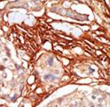 ARAF / ARAF1 / A-RAF Antibody - Formalin-fixed and paraffin-embedded human cancer tissue reacted with the primary antibody, which was peroxidase-conjugated to the secondary antibody, followed by AEC staining. This data demonstrates the use of this antibody for immunohistochemistry; clinical relevance has not been evaluated. BC = breast carcinoma; HC = hepatocarcinoma.