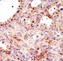 ARFGAP1 Antibody - Formalin-fixed and paraffin-embedded human cancer tissue reacted with the primary antibody, which was peroxidase-conjugated to the secondary antibody, followed by AEC staining. This data demonstrates the use of this antibody for immunohistochemistry; clinical relevance has not been evaluated. BC = breast carcinoma; HC = hepatocarcinoma.