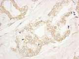 ARFGEF1 Antibody - Detection of Human BIG1/ARFGEF1 by Immunohistochemistry. Sample: FFPE section of human prostate carcinoma. Antibody: Affinity purified rabbit anti-BIG1/ARFGEF1 used at a dilution of 1:1000 (1 ug/ml).