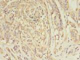 ARFIP2 / Arfaptin 2 Antibody - Immunohistochemistry of paraffin-embedded human breast cancer tissue using antibody at 1:100 dilution.