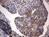 ARFL3 / ARL3 Antibody - IHC of paraffin-embedded Carcinoma of Human lung tissue using anti-ARL3 mouse monoclonal antibody. (Heat-induced epitope retrieval by 10mM citric buffer, pH6.0, 120°C for 3min).