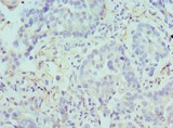 ARG2 / Arginase 2 Antibody - Immunohistochemistry of paraffin-embedded human lung cancer using antibody at 1:100 dilution.