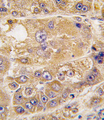 ARH / LDLRAP1 Antibody - Formalin-fixed and paraffin-embedded human hepatocarcinoma tissue reacted with LDLRAP1 antibody , which was peroxidase-conjugated to the secondary antibody, followed by DAB staining. This data demonstrates the use of this antibody for immunohistochemistry; clinical relevance has not been evaluated.