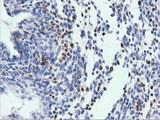 ARHGAP25 Antibody - Immunohistochemical staining of paraffin-embedded Carcinoma of Human prostate tissue using anti-ARHGAP25 mouse monoclonal antibody. (Dilution 1:50).
