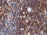 ARHGAP25 Antibody - Immunohistochemical staining of paraffin-embedded Human lymphoma tissue using anti-ARHGAP25 mouse monoclonal antibody. (Dilution 1:50).