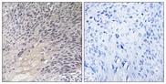 ARHGDIA / RHOGDI Antibody - Immunohistochemistry analysis of paraffin-embedded human cervix carcinoma tissue, using ARHGDIA Antibody. The picture on the right is blocked with the synthesized peptide.