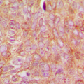ARHGDIA / RHOGDI Antibody - Immunohistochemical analysis of RhoGDI alpha (pS174) staining in human breast cancer formalin fixed paraffin embedded tissue section. The section was pre-treated using heat mediated antigen retrieval with sodium citrate buffer (pH 6.0). The section was then incubated with the antibody at room temperature and detected using an HRP conjugated compact polymer system. DAB was used as the chromogen. The section was then counterstained with hematoxylin and mounted with DPX.