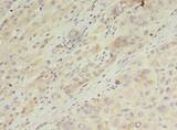 ARL14 Antibody - Immunohistochemistry of paraffin-embedded human liver cancer using antibody at dilution of 1:100.