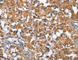 ARMCX2 Antibody - Immunohistochemistry of paraffin-embedded Human thyroid cancer using ARMCX2 Polyclonal Antibody at dilution of 1:40.