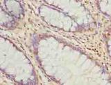 ARMT1 Antibody - Immunohistochemistry of paraffin-embedded human colon cancer using antibody at dilution of 1:100.
