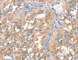 ARTS Antibody - Immunohistochemistry of paraffin-embedded Human thyroid cancer using PRPS1/2/1L1 Polyclonal Antibody at dilution of 1:50.