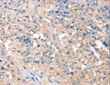 ARTS Antibody - Immunohistochemistry of paraffin-embedded Human thyroid cancer using PRPS1/2/1L1 Polyclonal Antibody at dilution of 1:30.