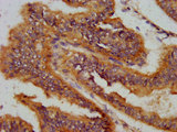 AS3MT Antibody - Immunohistochemistry image at a dilution of 1:400 and staining in paraffin-embedded human endometrial cancer performed on a Leica BondTM system. After dewaxing and hydration, antigen retrieval was mediated by high pressure in a citrate buffer (pH 6.0) . Section was blocked with 10% normal goat serum 30min at RT. Then primary antibody (1% BSA) was incubated at 4 °C overnight. The primary is detected by a biotinylated secondary antibody and visualized using an HRP conjugated SP system.
