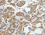 ASAH1 / Acid Ceramidase Antibody - Immunohistochemistry of paraffin-embedded Human breast cancer using ASAH1 Polyclonal Antibody at dilution of 1:40.