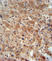 ASAP3 Antibody - ASAP3 antibody immunohistochemistry of formalin-fixed and paraffin-embedded human hepatocarcinoma followed by peroxidase-conjugated secondary antibody and DAB staining.
