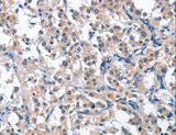 ASB2 Antibody - Immunohistochemistry of paraffin-embedded Human thyroid cancer using ASB2 Polyclonal Antibody at dilution of 1:40.