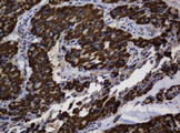 ASGR2 Antibody - IHC of paraffin-embedded Carcinoma of Human thyroid tissue using anti-ASGR2 mouse monoclonal antibody.