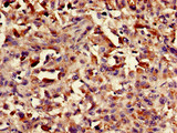 ASH1L / ASH1 Antibody - Immunohistochemistry of paraffin-embedded human melanoma cancer using ASH1L Antibody at dilution of 1:100