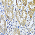 ASIP Antibody - Immunohistochemistry of paraffin-embedded human gastric cancer tissue.