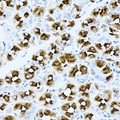 ASMTL Antibody - Immunohistochemical analysis of ASMTL staining in human gastric cancer formalin fixed paraffin embedded tissue section. The section was pre-treated using heat mediated antigen retrieval with sodium citrate buffer (pH 6.0). The section was then incubated with the antibody at room temperature and detected using an HRP conjugated compact polymer system. DAB was used as the chromogen. The section was then counterstained with hematoxylin and mounted with DPX.