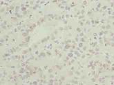 ASNSD1 Antibody - Immunohistochemistry of paraffin-embedded human liver cancer using antibody at dilution of 1:100.